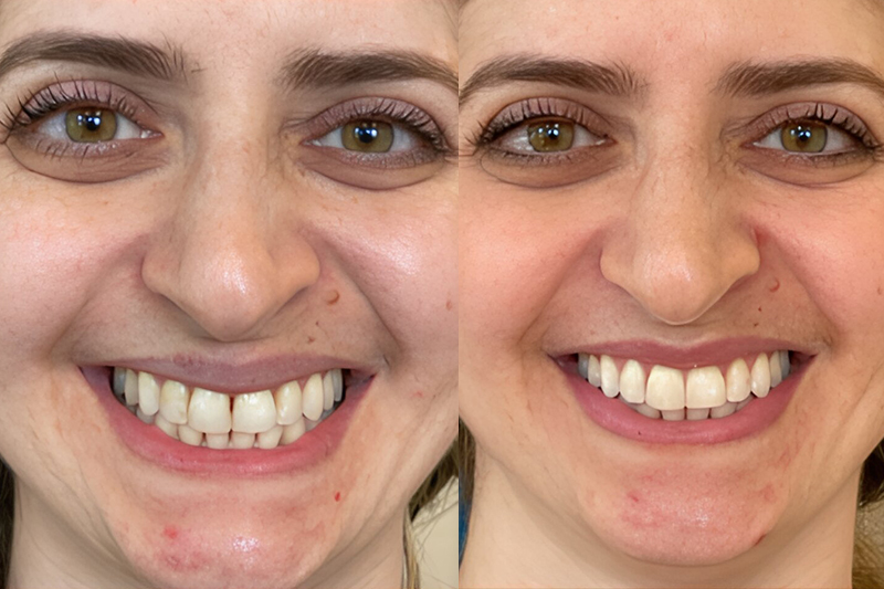 Dark Triangle/Diastema in Los Angeles