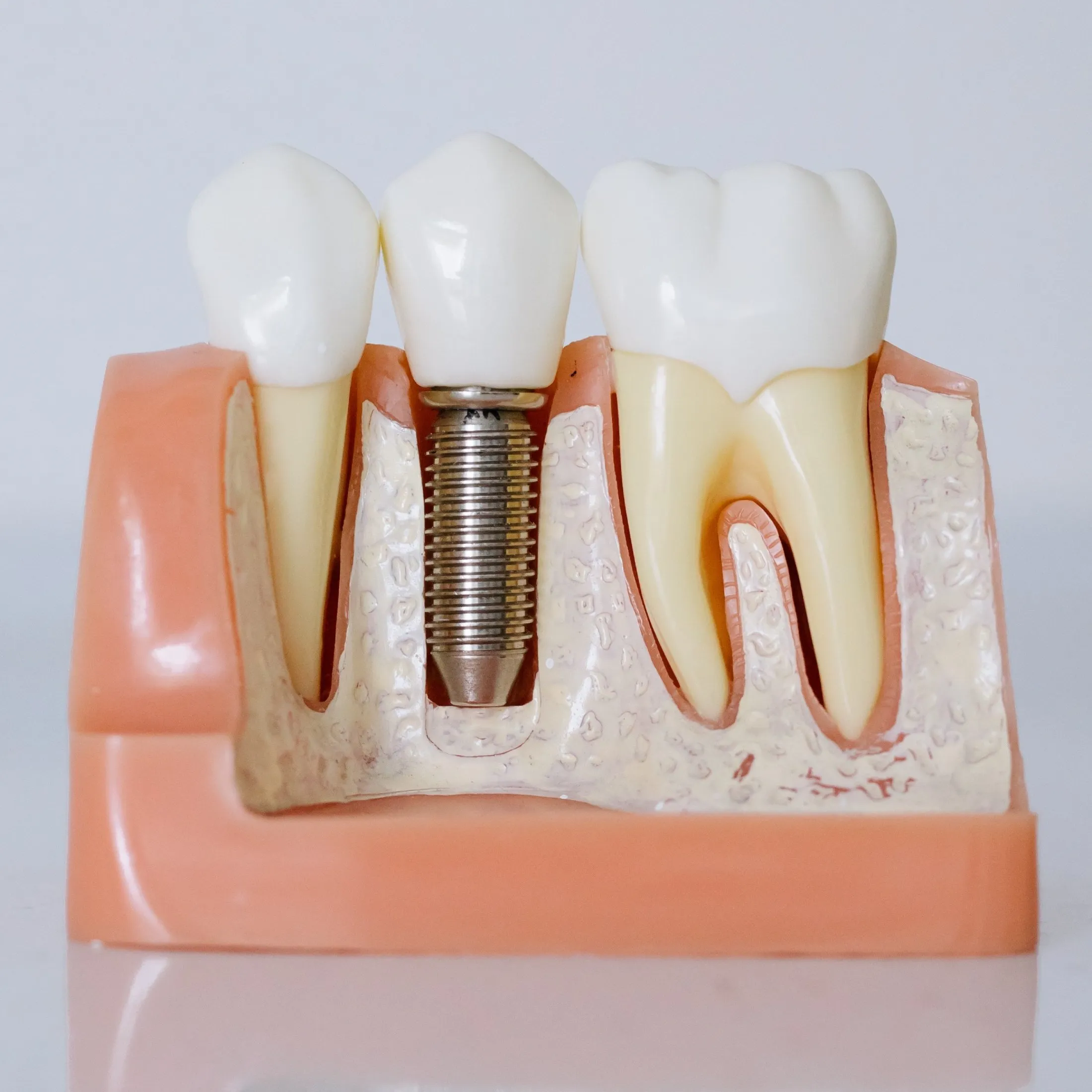 Dental Implants